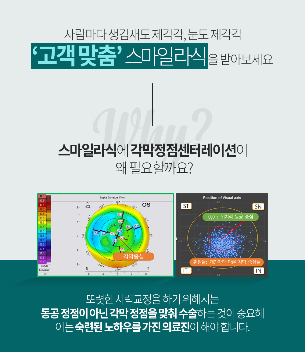 사람마다 생김새도 제각각, 눈도 제각각 ‘고객 맞춤’ 스마일 라식을 받아보세요. 스마일라식에 각막정점센터레이션이 왜 필요할까요?