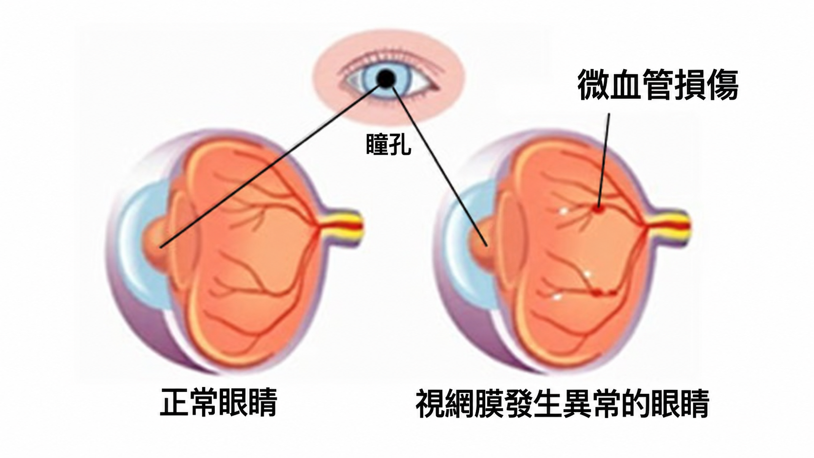 糖尿病視網膜病變與微血管損傷示意