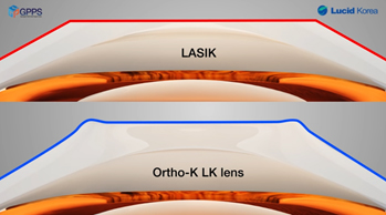 LASIK 與角膜塑形鏡的示意比較